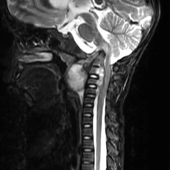 MRI CV Junction and Cervical Spine